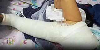 女婴被大狗撞致十级伤残 狗主拒赔被拘
